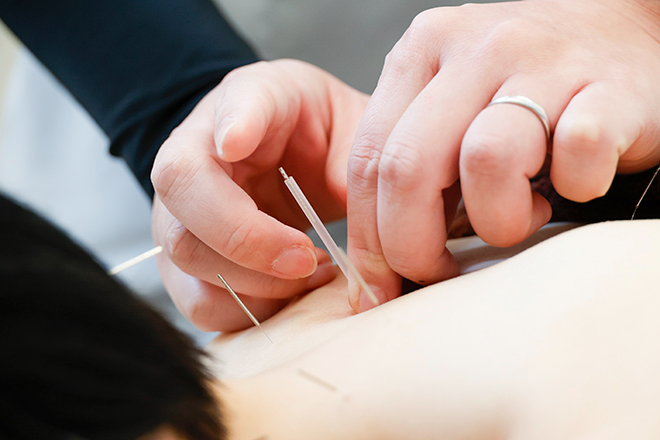 鍼灸施術で不調改善！Acupuncture treatmentのイメージ